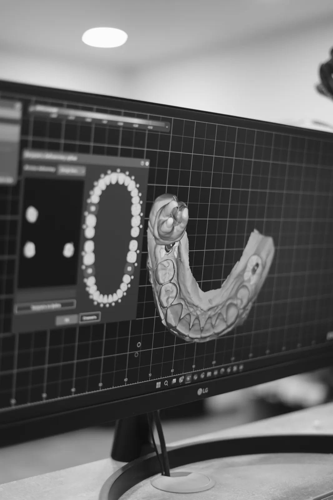 Skan cyfrowy z pozycjami implantów i schematem zębów